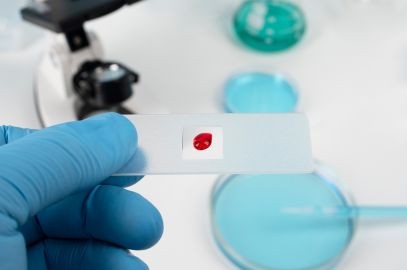Zdjęcie artykułu - Anemia sierpowata - przyczyny, objawy i leczenie niedokrwistości sierpowatej. Jak przebiega diagnostyka tej choroby?