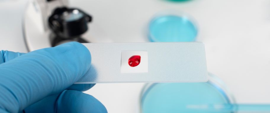 Arykuł banner - Anemia sierpowata - przyczyny, objawy i leczenie niedokrwistości sierpowatej. Jak przebiega diagnostyka tej choroby?