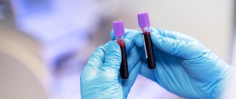 Arykuł banner - Badania na boreliozę przy objawach choroby z Lyme: testy przesiewowe, testy ELISA, badania w kierunku boreliozy (IgG) na obecność przeciwciał, test na boreliozę u kleszcza i inne
