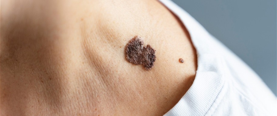 Arykuł banner - Czym jest bliznowiec (keloid)? Przyczyny powstawania, rozpoznanie, leczenie. Keloid a blizna przerostowa.