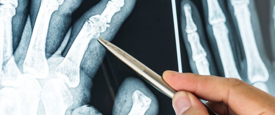 Arykuł banner - Wrodzona łamliwość kości: typy schorzenia, objawy, dziedziczenie, diagnostyka i możliwości leczenia