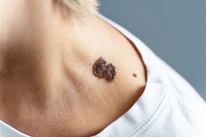 Zdjęcie artykułu - Czym jest bliznowiec (keloid)? Przyczyny powstawania, rozpoznanie, leczenie. Keloid a blizna przerostowa.