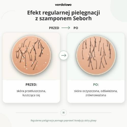 #2 – SEBORH Szampon do łojotokowej sk&oacute;ry głowy, 200ml