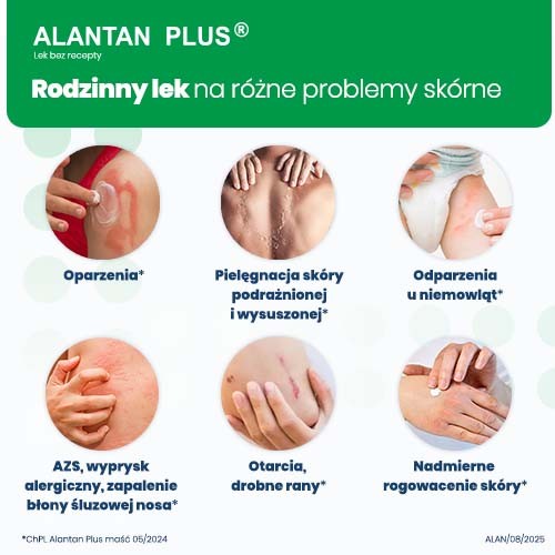 Miniaturka artykułu - #1 ALANTAN PLUS Maść, 30 g 