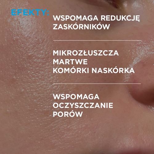 Miniaturka artykułu - #1 Idee Derm Serum zwalczające trądzik z kwasami, 30 ml