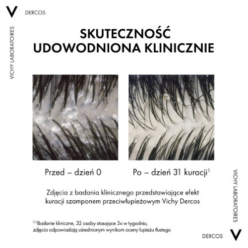 Zdjęcie produktu - 3 Vichy Dercos DS Szampon przeciwłupieżowy do włos&oacute;w normalnych i tłustych, 390 ml