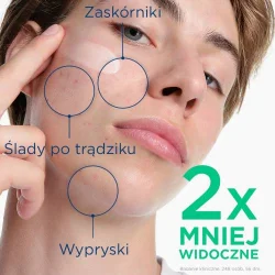 Miniaturka artykułu - #0 BIODERMA S&eacute;bium Kerato+ Żel-Krem Przeciwtrądzikowy, 30ml